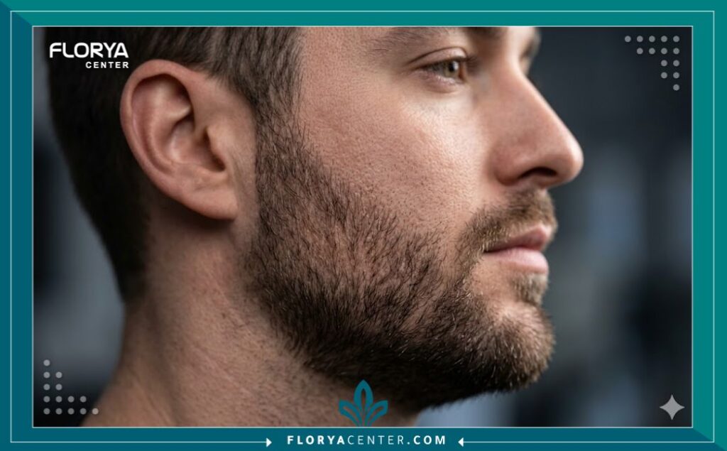 لقطة قريبة توضح الاتجاه الطبيعي والكثافة العالية لبصيلات الشعر المزروعة حديثًا في منطقة الذقن والفك.