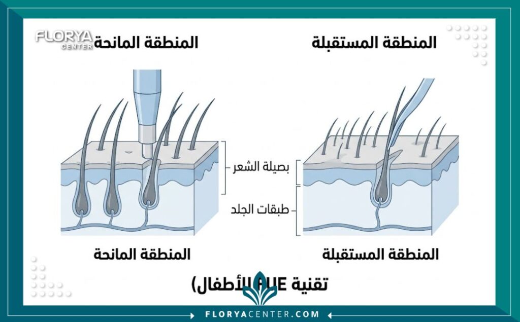 رسم تخطيطي طبي يوضح كيفية نقل بصيلات الشعر في عملية زراعة الشعر للأطفال.
