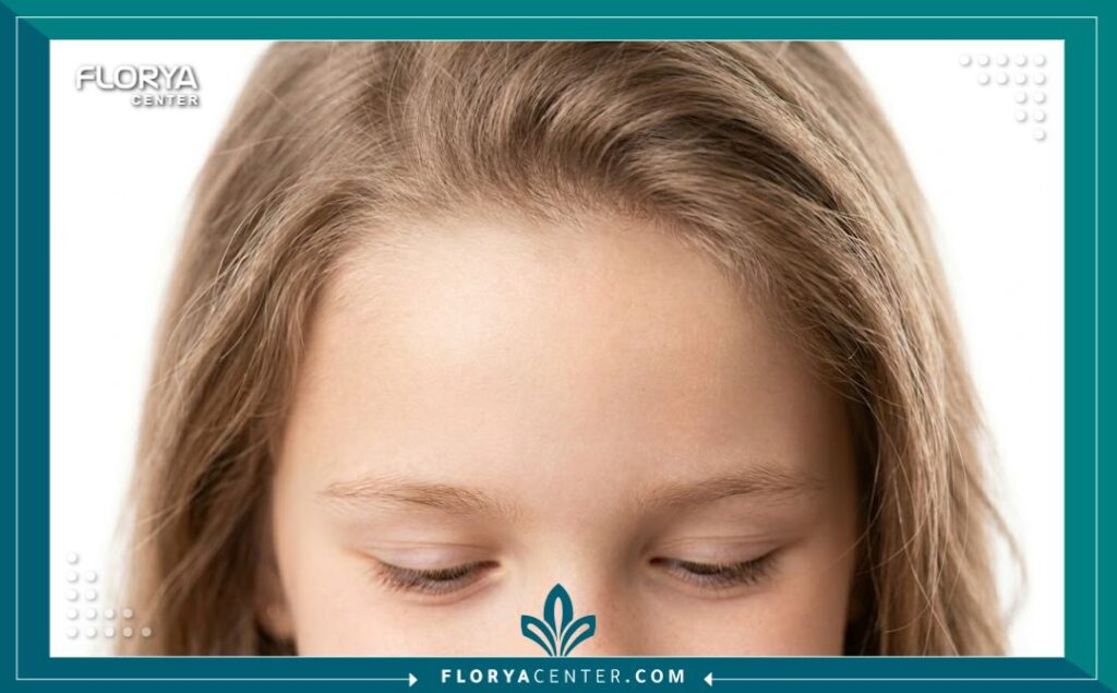 لقطة مكبرة تظهر كثافة ومظهر الشعر الطبيعي بعد زراعة الشعر لطفلة لعلاج آثار ندبة.