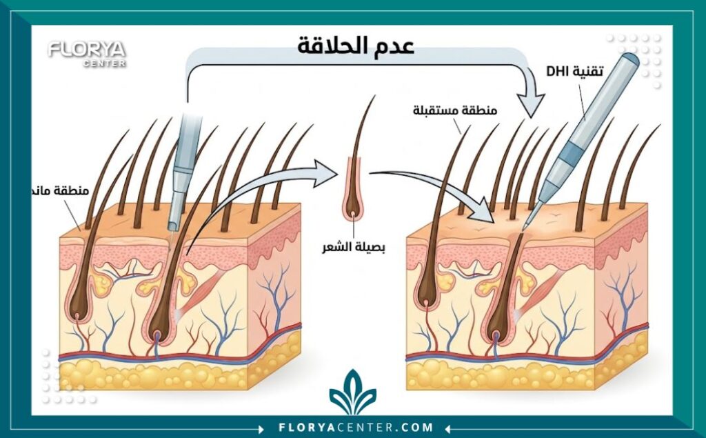 توضيح طبي لتقنية DHI لزراعة الشعر للنساء بدون حلاقة، يظهر استخراج وزراعة البصيلات دون المساس بالشعر الطويل الموجود.
