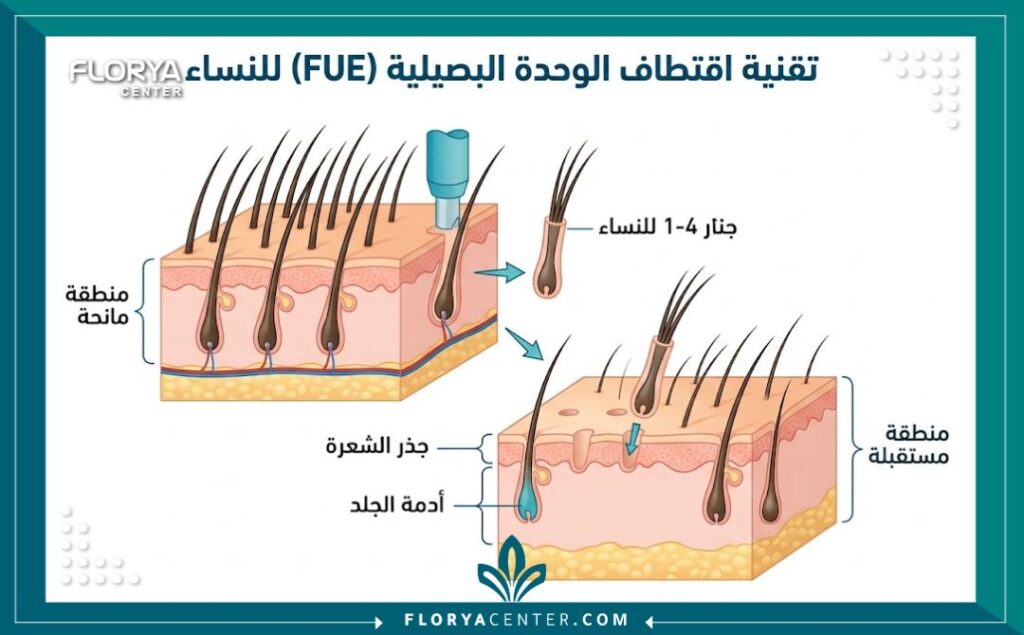 رسم توضيحي طبي يوضح تقنية FUE لزراعة الشعر للنساء في مصر، يظهر فروة الرأس والبصيلات والمنطقة المانحة والمستقبلة.