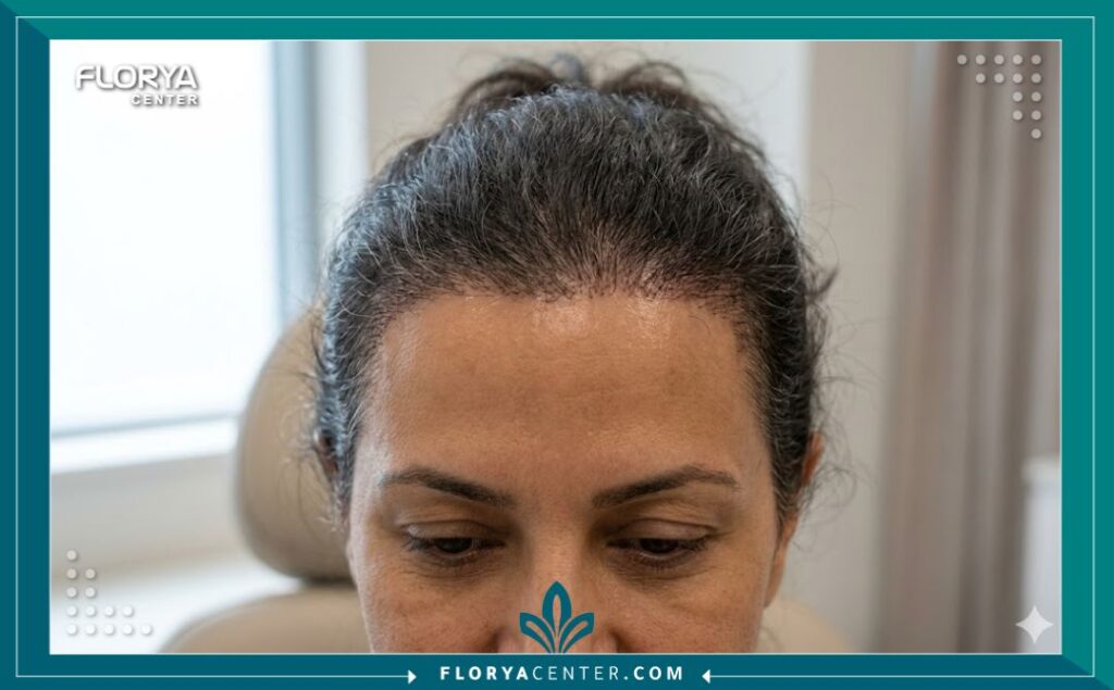 لقطة مقربة احترافية عالية الدقة تُظهر خط الشعر الأمامي الطبيعي ونمو الشعر الجديد بعد عملية زراعة شعر ناجحة لدى سيدة، مع إضاءة جمالية ناعمة.