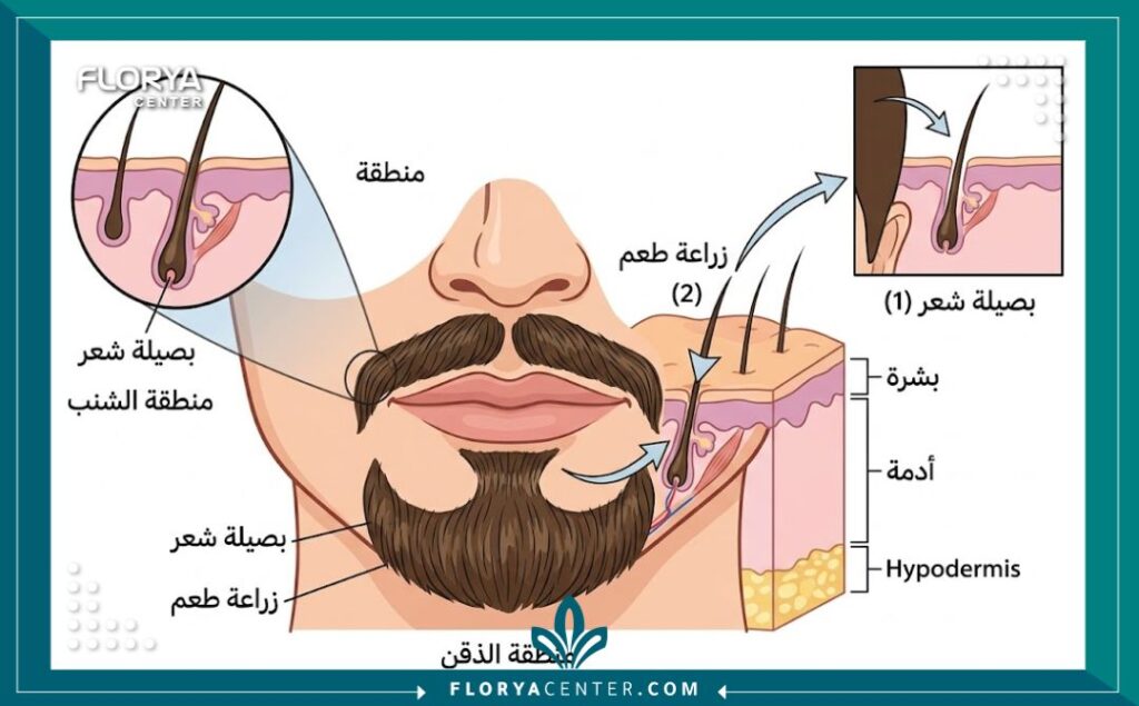 مخطط طبي تشريحي يوضح عملية زراعة شعر الوجه، مع تسميات دقيقة باللغة العربية تشير إلى مناطق الشنب والذقن وبصيلات الشعر.