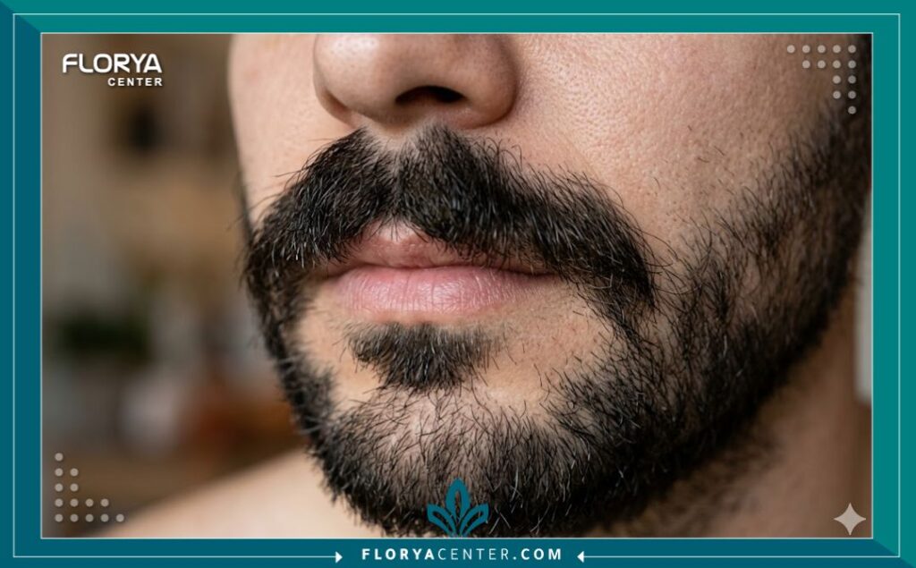 صورة قريبة (زوم) تبرز كثافة ومظهر شنب الرجل الطبيعي والجذاب بعد الخضوع لعملية تكثيف الشارب.