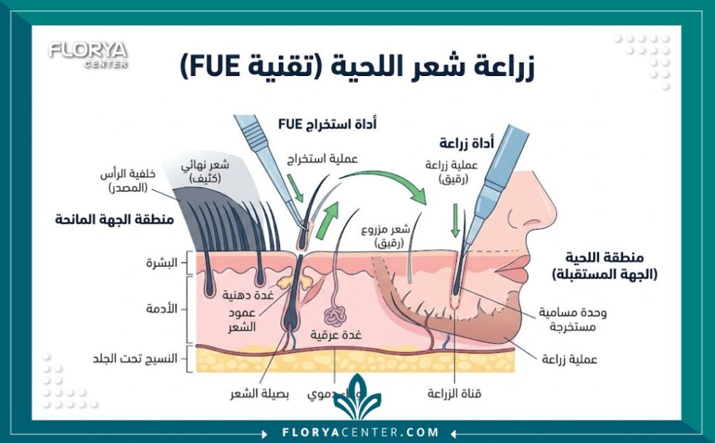 رسم تخطيطي طبي يشرح كيفية استخراج وزراعة بصيلات الشعر لزيادة كثافة اللحية والذقن.