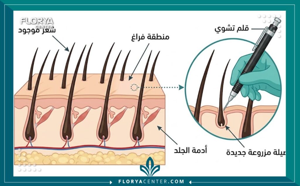 رسم تخطيطي طبي يوضح آلية زراعة تكثيف الشعر باستخدام تقنية DHI لملء الفراغات بين البصيلات الموجودة دون جراحة.