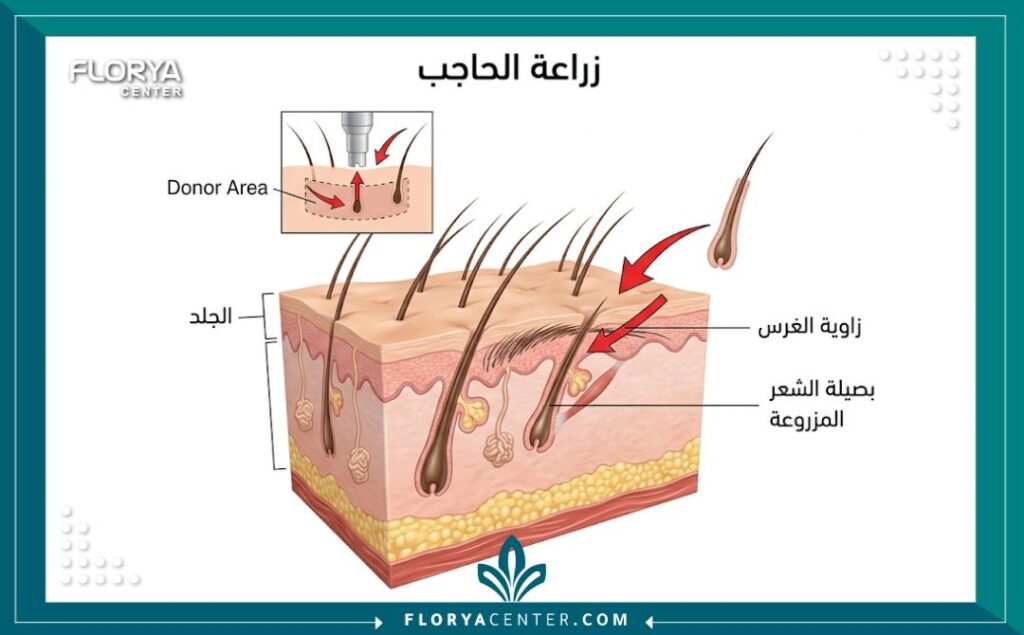رسم تخطيطي طبي يوضح تشريح الجلد وكيفية غرس بصيلات الشعر بدقة أثناء عملية زراعة شعر الحاجبين