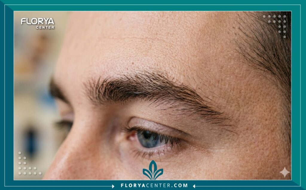 لقطة قريبة مكبرة تظهر تفاصيل نمو واتجاه شعيرات الحاجب المزروعة حديثاً للرجال للحصول على مظهر طبيعي وكثيف.