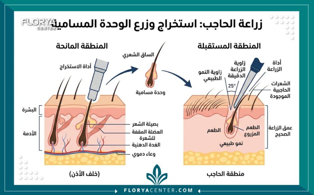 مخطط طبي توضيحي يوضح عملية زراعة شعر الحواجب في مصر، من مرحلة اقتطاف البصيلات من المنطقة المانحة إلى غرسها بزاوية دقيقة في الحاجب.