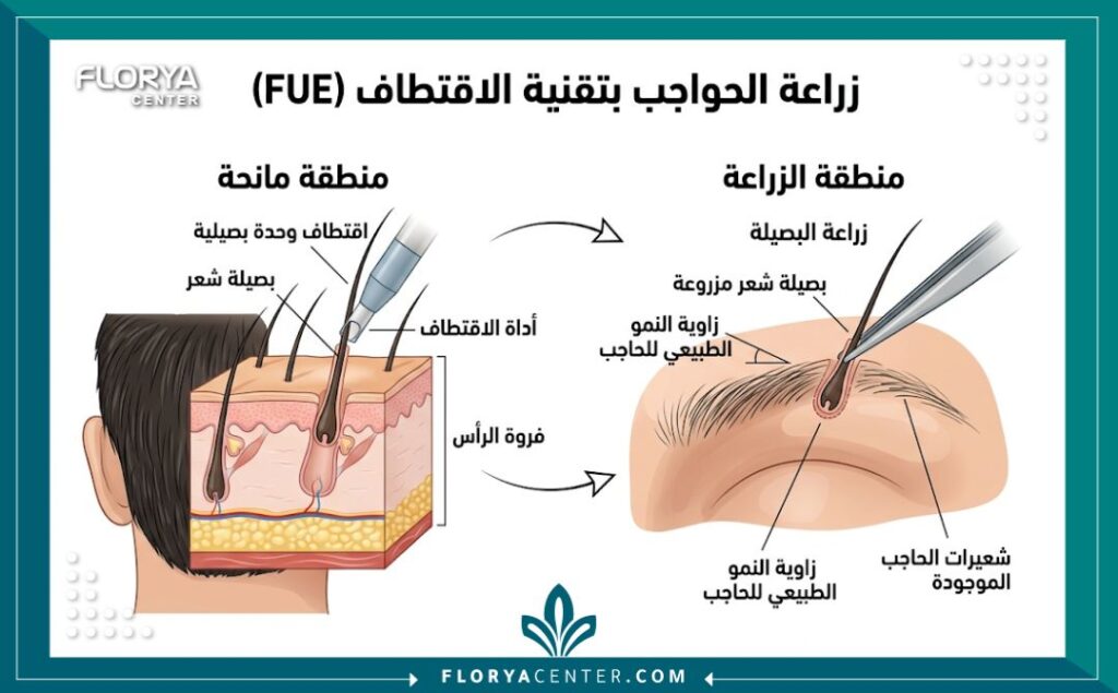 رسم تخطيطي طبي يوضح كيفية نقل بصيلات الشعر وزراعتها في الحواجب.