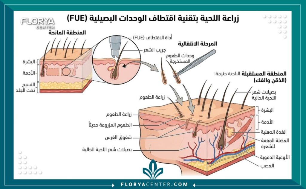رسم تخطيطي طبي يوضح تقنية زراعة شعر الذقن قبل وبعد (FUE) وكيفية نقل البصيلات.
