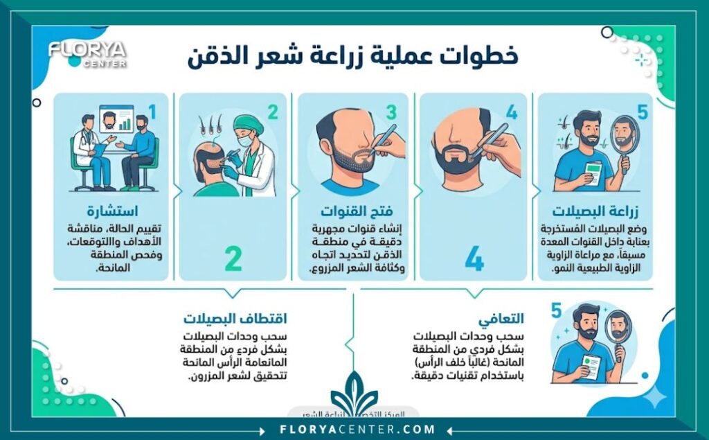 إنفوجرافيك يوضح خطوات عملية زراعة شعر الذقن بالتفصيل.