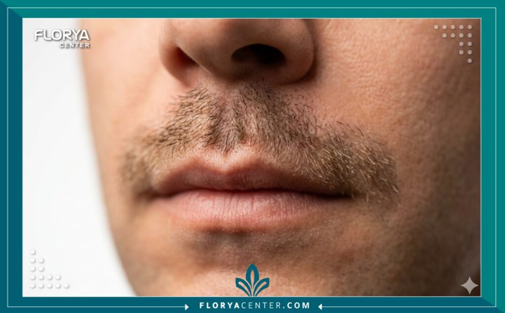 لقطة مكبرة جمالية تبرز كثافة وتحديد شعر الشنب الجديد بعد عملية الزراعة