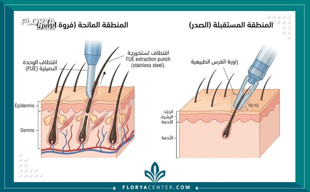 رسم توضيحي طبي يوضح خطوات تقنية اقتطاف البصيلات (FUE) لزراعة شعر الصدر، يظهر كيفية نقل البصيلات من فروة الرأس وغرسها في جلد الصدر بزاوية طبيعية.