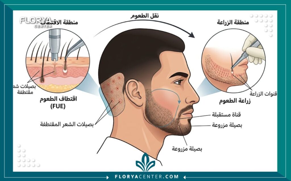 مخطط طبي يوضح تقنية اقتطاف الوحدة البصيلية (FUE) المستخدمة في زراعة شعر اللحية في تركيا، مع توضيح مناطق الاقتطاف والزراعة باللغة العربية.