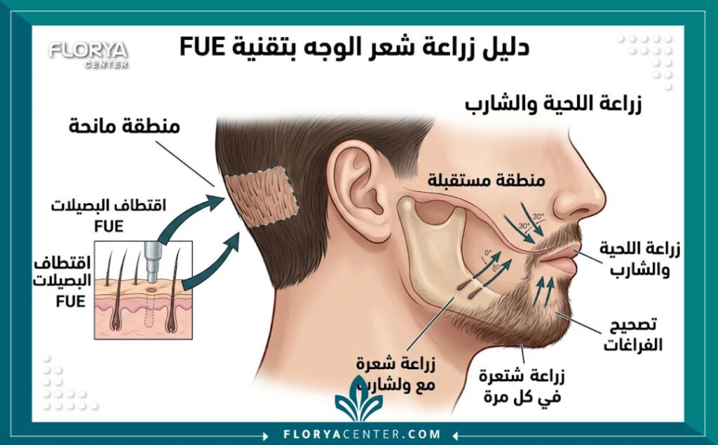 رسم تخطيطي طبي يوضح عملية زراعة شعر الوجه بتقنية FUE، من استخراج البصيلات من المنطقة المانحة وزراعتها في مناطق اللحية والشارب.