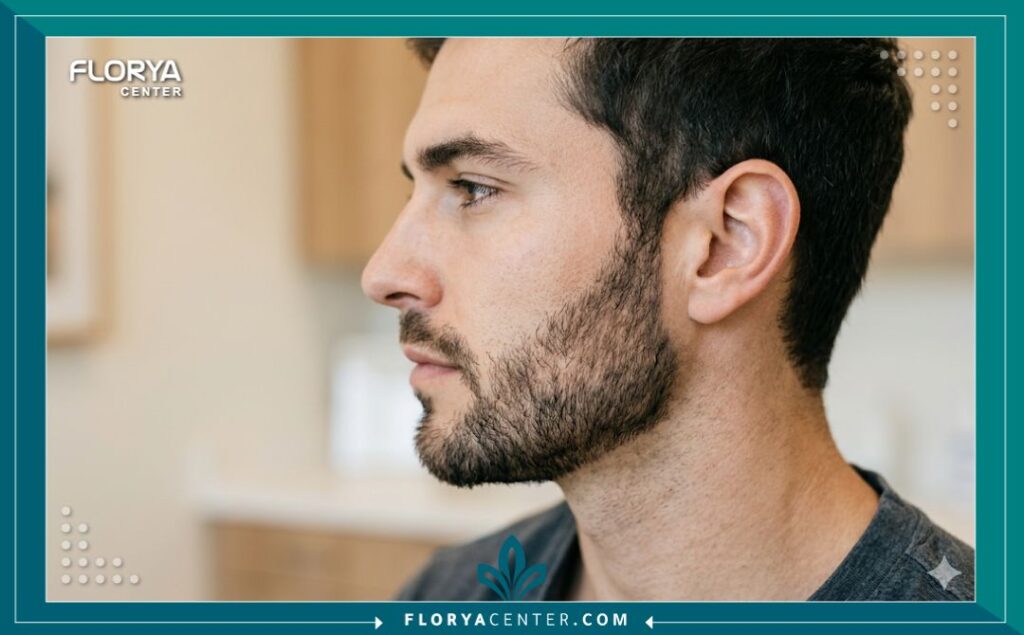 لقطة مقربة تظهر دقة خط اللحية المزروع والكثافة الطبيعية للشعر المزروع في منطقة السوالف والفك بعد عملية زراعة شعر الوجه.