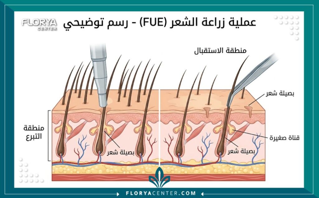 رسم تخطيطي طبي يوضح خطوات تقنية زراعة الشعر FUE، من استخراج البصيلات إلى زراعتها.