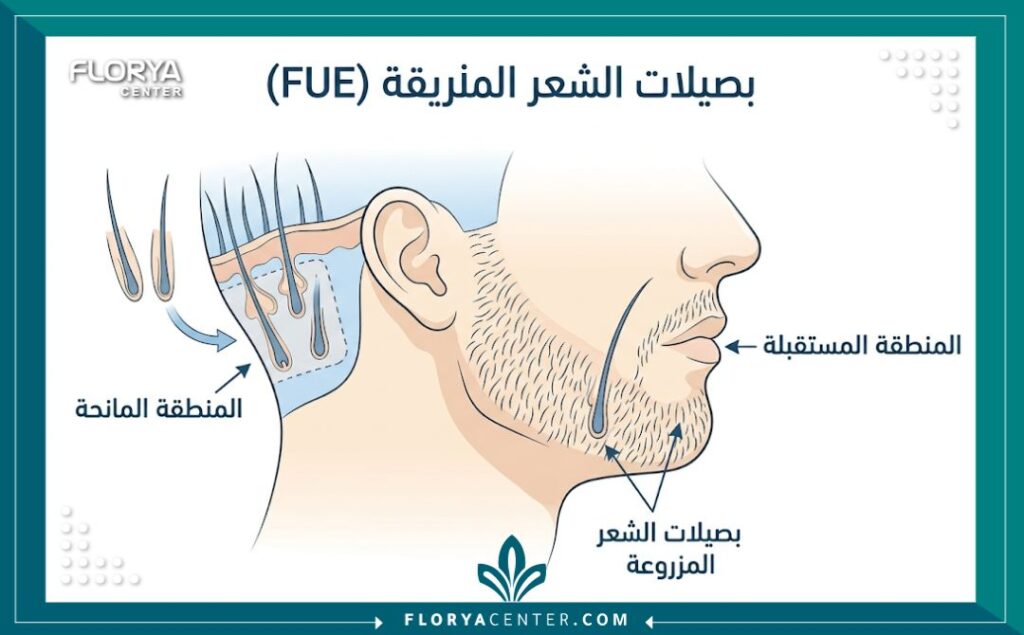 مخطط طبي يوضح تقنية اقتطاف البصيلات (FUE) المستخدمة في زراعة شعر الدقن لتعبئة الفراغات.