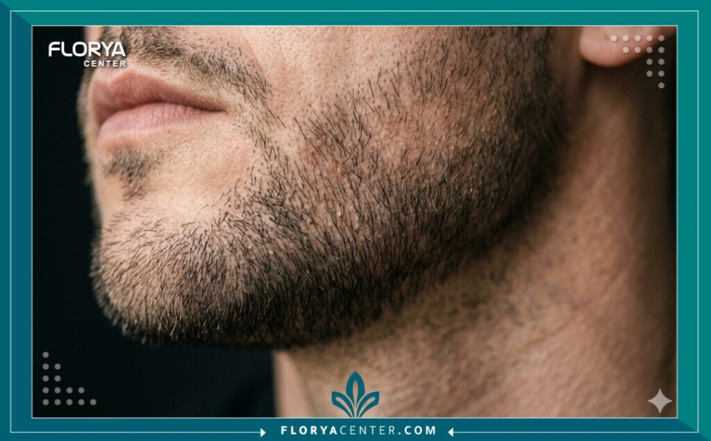 لقطة مكبرة جمالية تظهر دقة وكثافة واتجاه نمو بصيلات الشعر المزروعة حديثاً في منطقة الذقن.