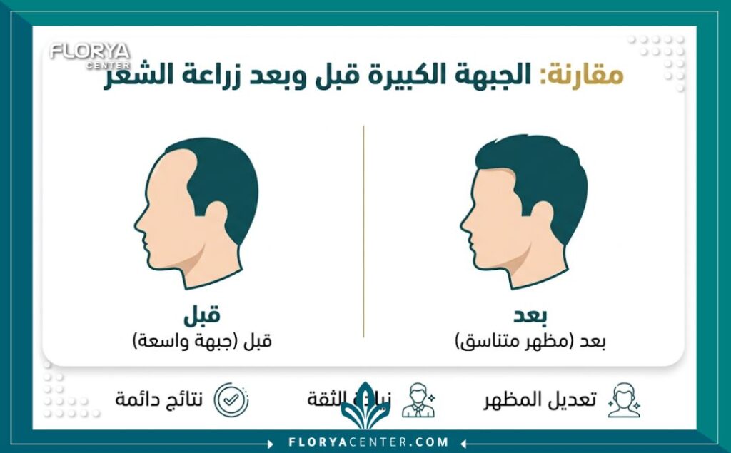 إنفوجرافيك مقارنة بين شكل الوجه قبل وبعد زراعة شعر للجبهه الكبيره، يوضح فرق تناسق ملامح الوجه وفوائد العملية.