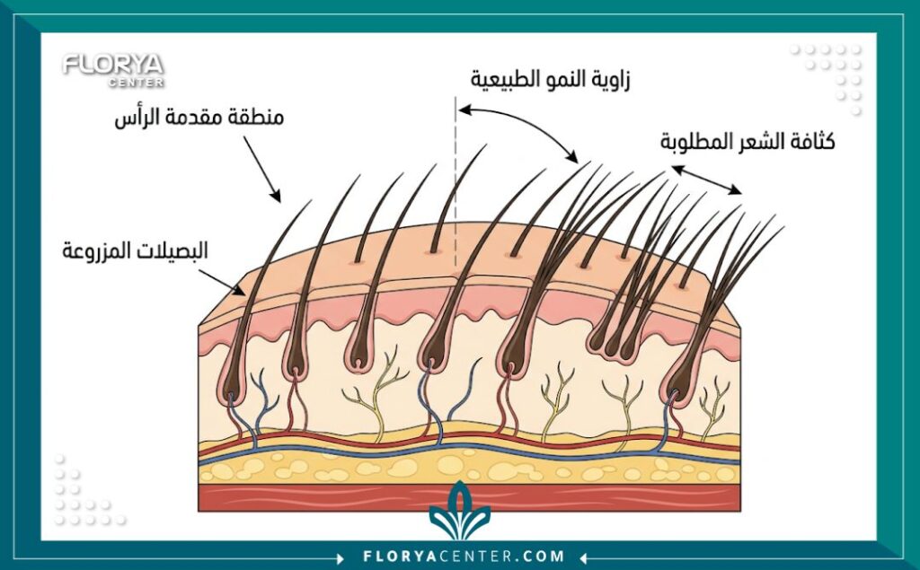 مخطط طبي يوضح كيفية زرع بصيلات الشعر في مقدمة الرأس للنساء لتصحيح خط الشعر والفراغات.