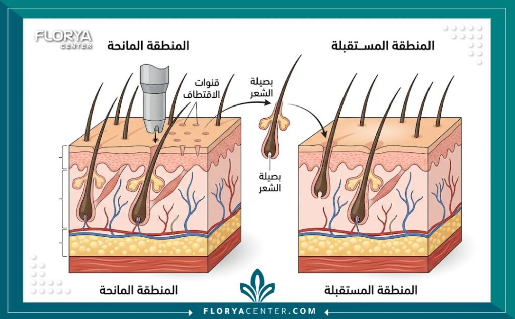 رسم تخطيطي طبي يوضح خطوات تقنية الاقتطاف FUE لزراعة الشعر في العيادات الإيرانية.