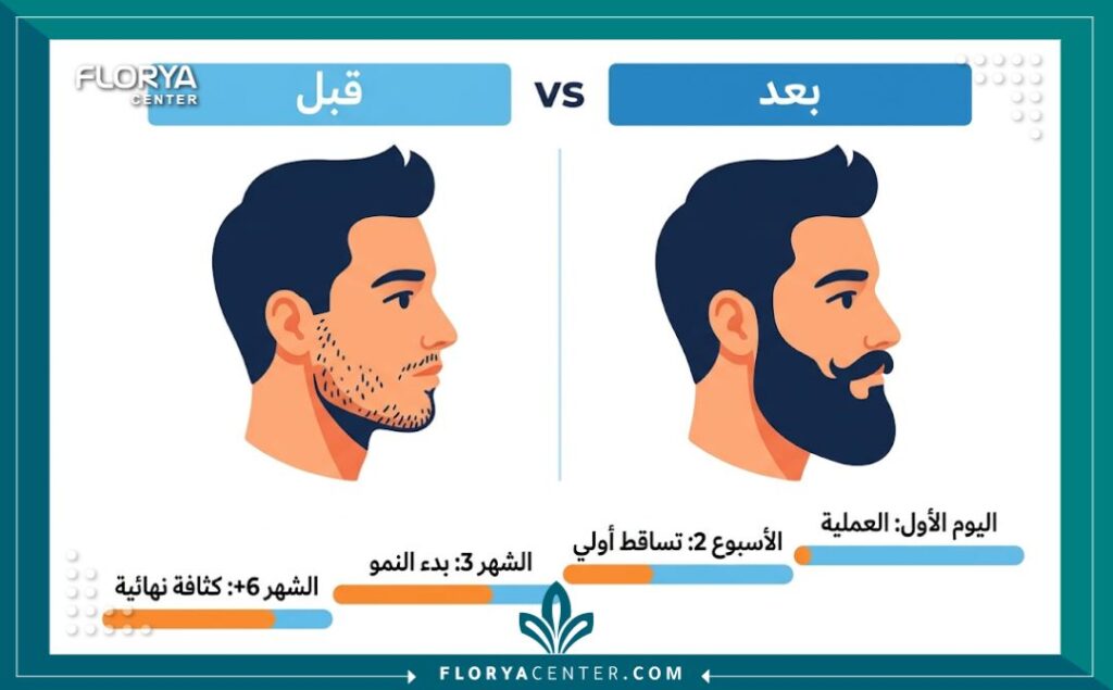 إنفوجرافيك يوضح مقارنة بين قبل وبعد زرع شعر الذقن، مع جدول زمني لمراحل نمو الشعر والكثافة النهائية.