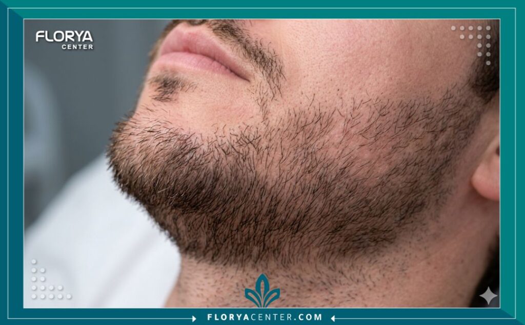 لقطة مكبرة قريبة تظهر بوضوح نمو بصيلات الشعر المزروعة حديثاً في منطقة الذقن والفك، تبرز النتائج الطبيعية للكثافة.