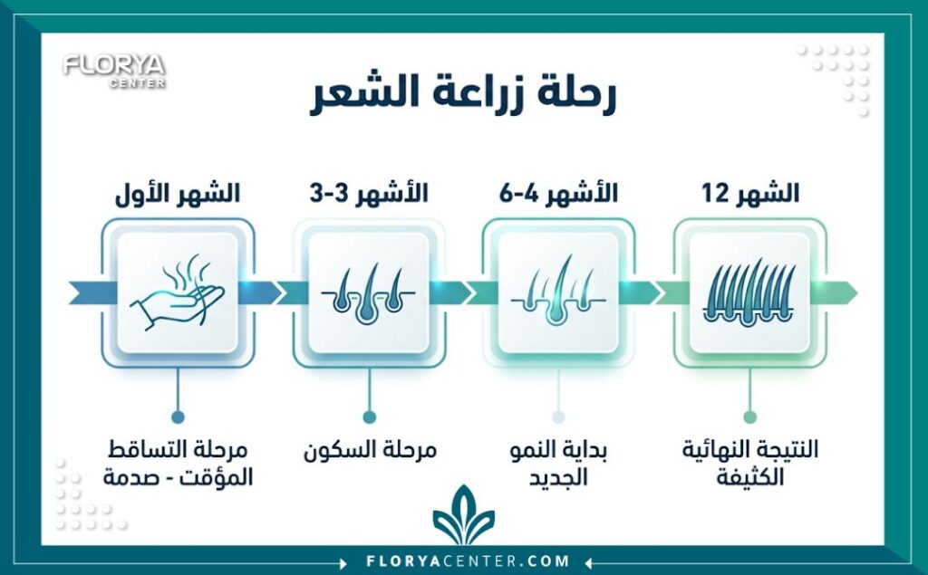 انفوجرافيك يوضح الجدول الزمني لمراحل نمو وسقوط الشعر المزروع، مبرزاً فترة تساقط الشعر المزروع المؤقت كجزء طبيعي من دورة النمو.