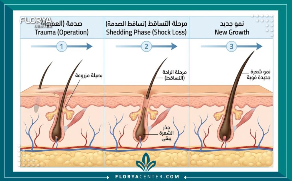 رسم تخطيطي طبي يوضح دورة حياة بصيلة الشعر المزروعة، يظهر مرحلة تساقط الصدمة المؤقت وكيف تبقى الجذور حية لإنتاج شعر جديد.