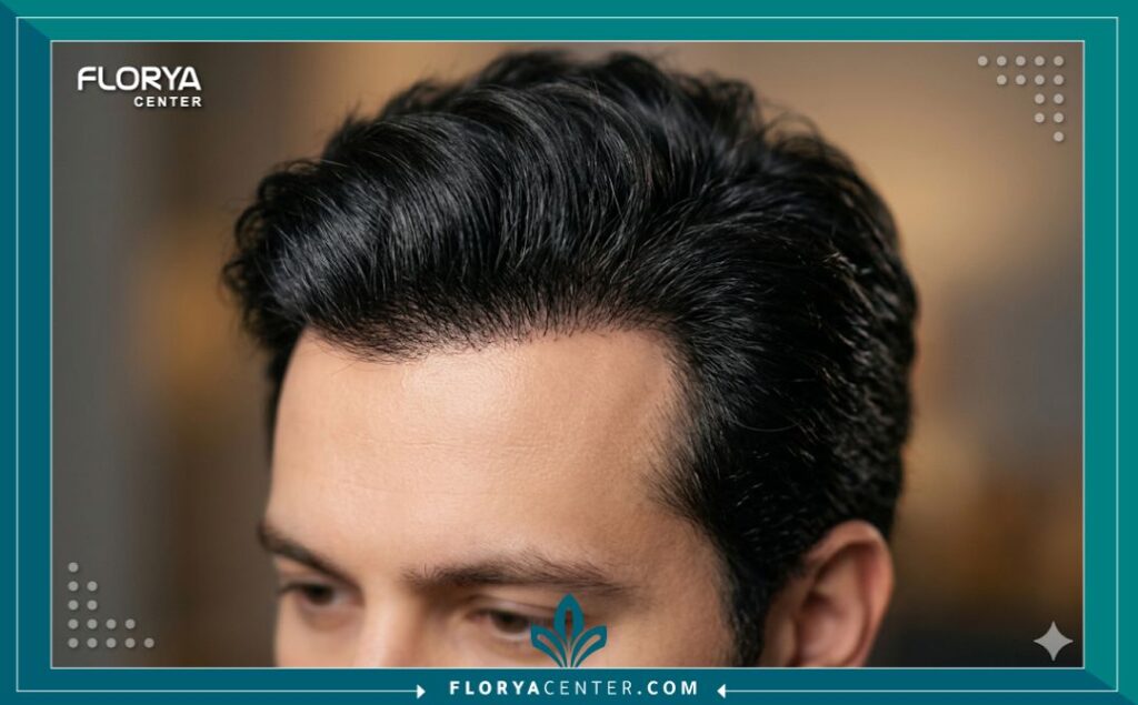 لقطة قريبة جمالية تركز على كثافة ومظهر الشعر الطبيعي بعد عام من زراعة الشعر، النتيجة النهائية الناجحة بعد تجاوز مرحلة سقوط الشعر بعد الزراعه.