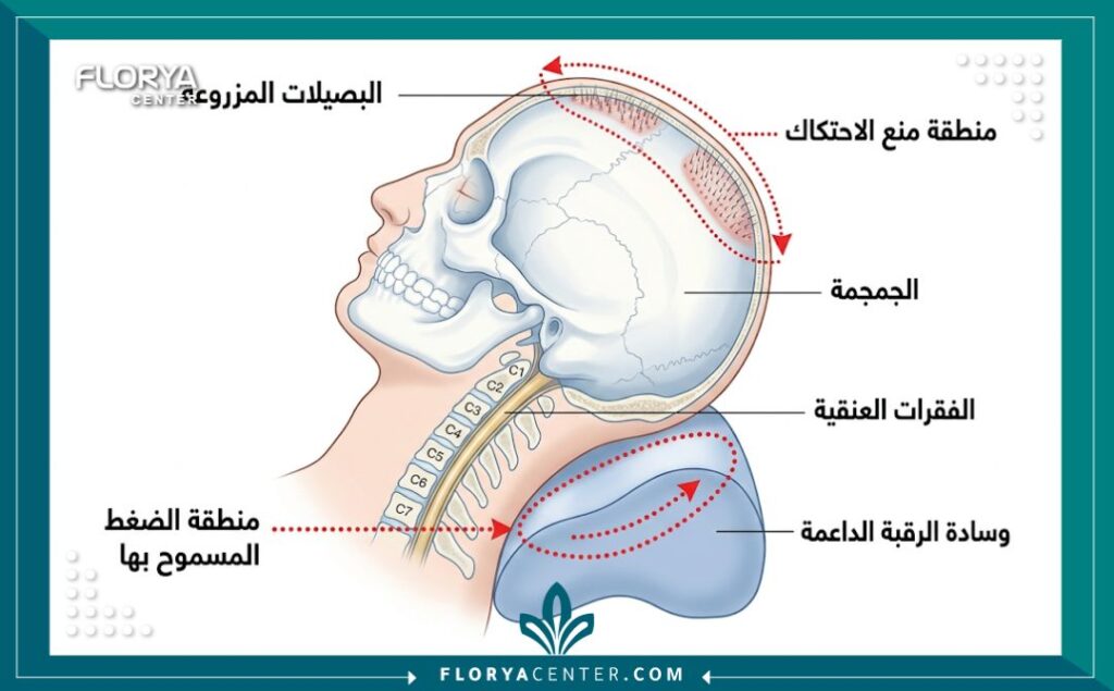 رسم بياني طبي يشرح تشريح الرأس والرقبة بعد زراعة الشعر، موضحًا كيفية وضع وسادة الرقبة الداعمة لمنع الاحتكاك بالبصيلات المزروعة.