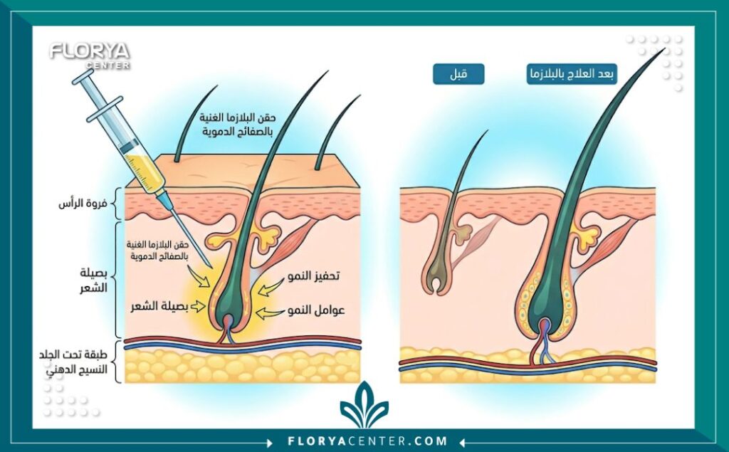 رسم تخطيطي طبي يوضح كيفية تأثير حقن البلازما (PRP) في تحفيز وتنشيط بصيلات الشعر الضعيفة.