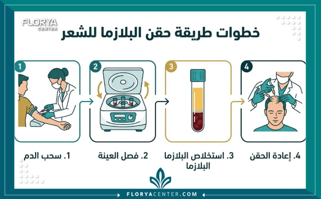 إنفوجرافيك يوضح خطوات طريقة حقن البلازما الغنية بالصفائح الدموية (PRP) للشعر بالتفصيل.