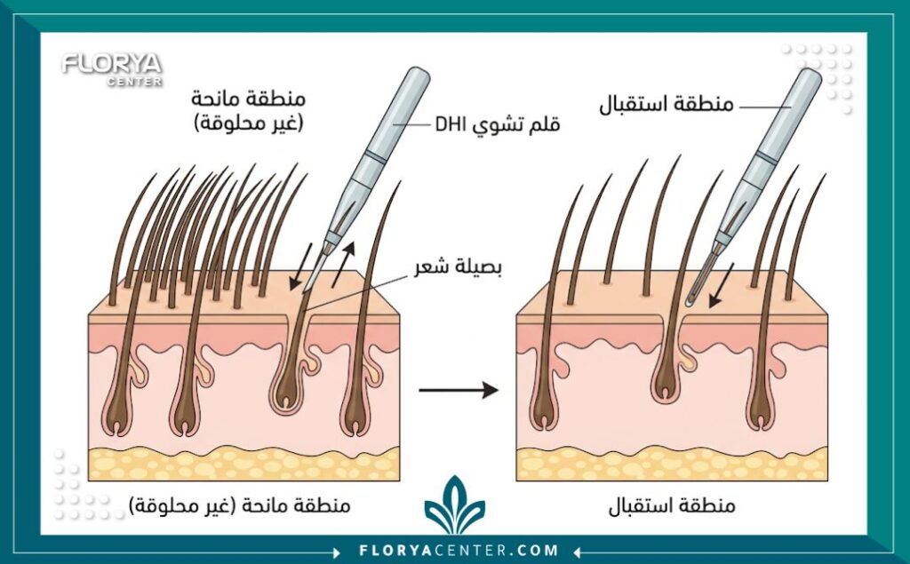 مخطط طبي يوضح طريقة زراعة الشعر للنساء بتقنية DHI بدون حلاقة، يظهر كيفية اقتطاف وغرس البصيلات بين الشعر الطويل الموجود.