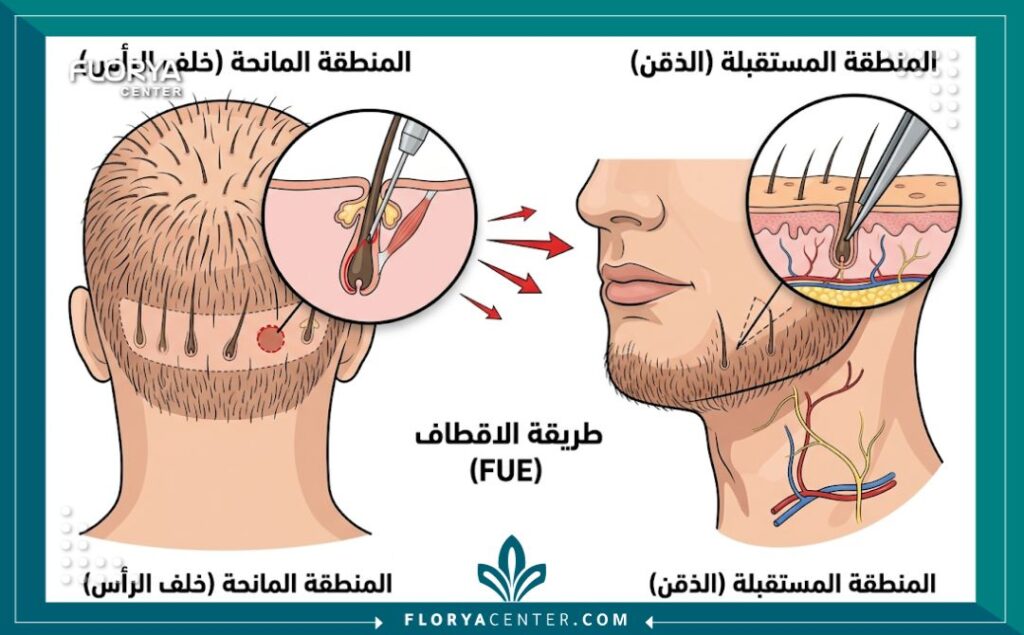 مخطط طبي توضيحي يشرح آلية اقتطاف البصيلات من خلف الرأس وزراعتها في منطقة الذقن (طريقة FUE).