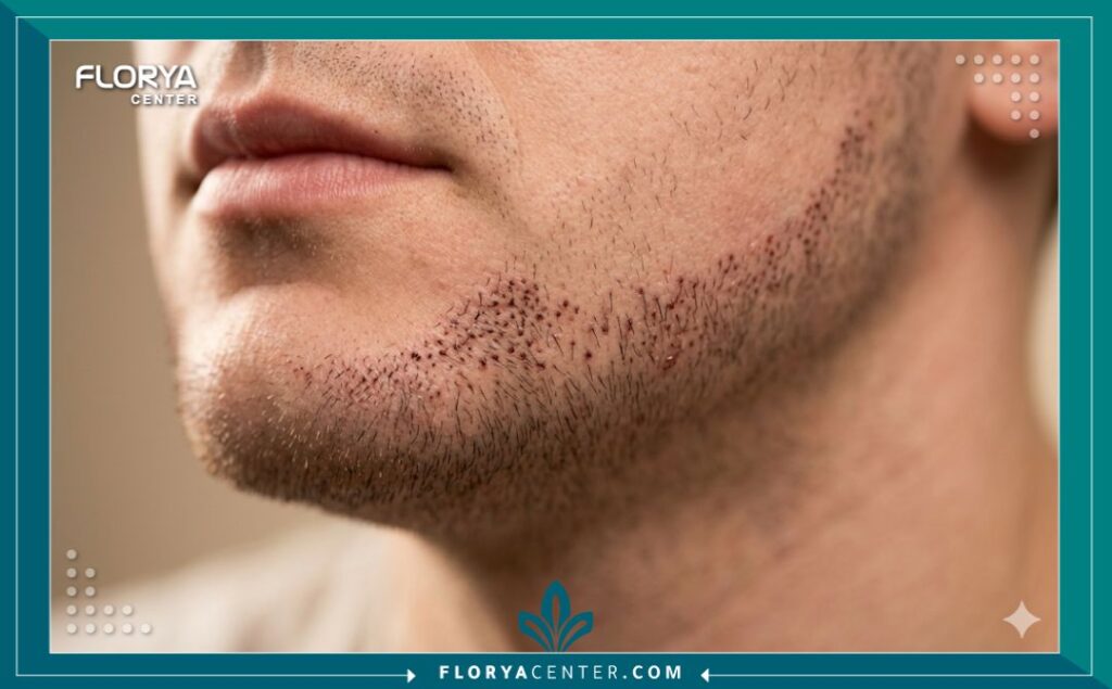 صورة ماكرو مقربة جداً تظهر توزيع بصيلات الشعر المزروعة حديثاً والدقة في تحديد خط الذقن.