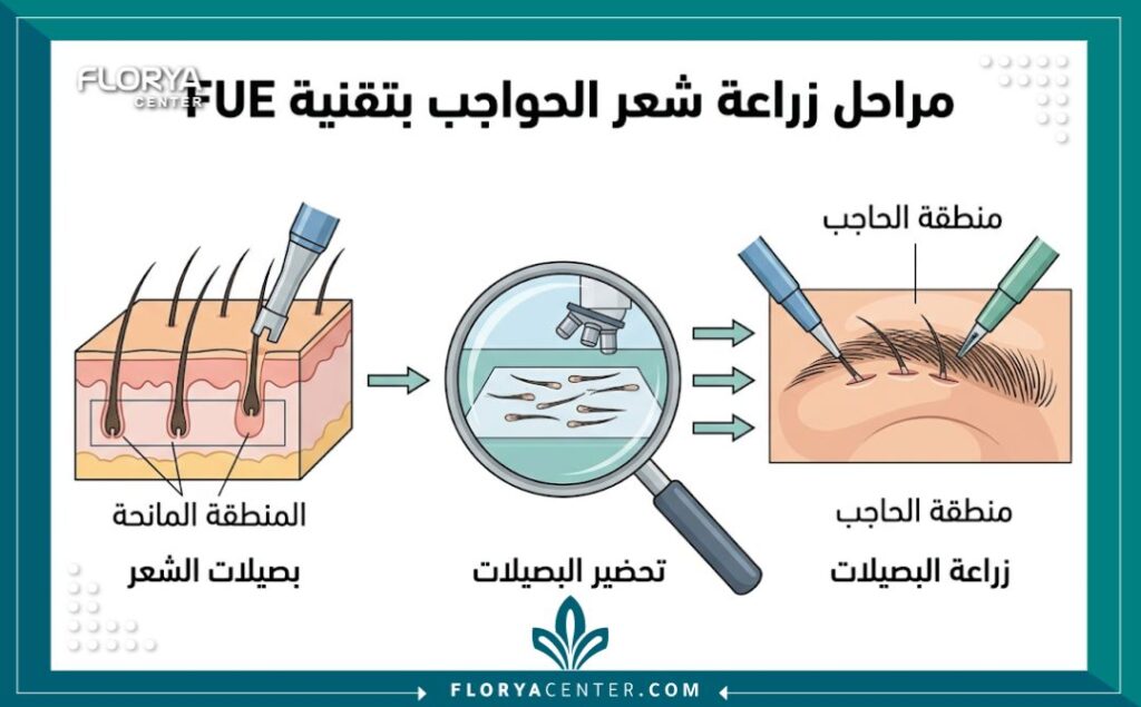 رسم تخطيطي طبي يوضح خطوات زراعة شعر الحواجب، من استخراج البصيلات وحتى زراعتها في الحاجب