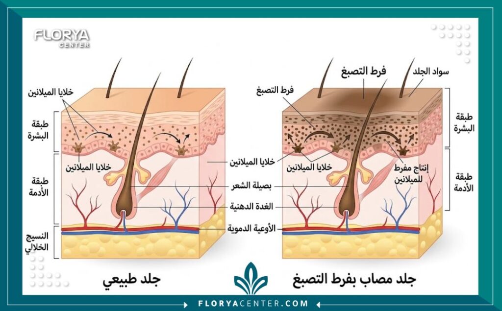 رسم تخطيطي طبي يوضح طبقات الجلد وكيفية حدوث فرط التصبغ (السواد) في المناطق الحساسة بسبب خلايا الميلانين.