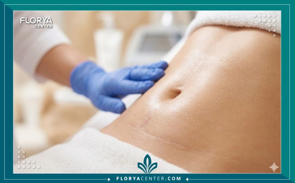 نتائج تجميل وإزالة آثار العمليات الجراحية والولادة باستخدام التقنيات الحديثة.