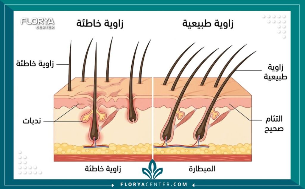 رسم تخطيطي طبي يقارن بين زاوية غرس بصيلات الشعر الخاطئة في العمليات الفاشلة والزاوية الطبيعية الصحيحة في عمليات تصحيح زرع الشعر.