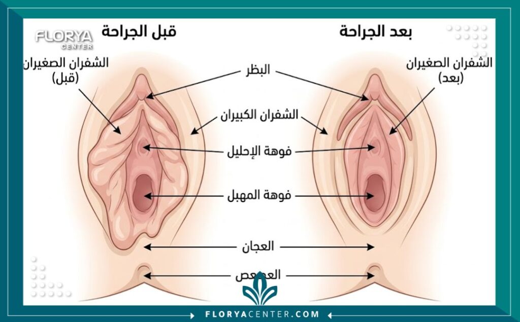  رسم تخطيطي طبي يوضح تشريح المهبل قبل وبعد عملية تجميل الشفرين مع تسميات باللغة العربية.