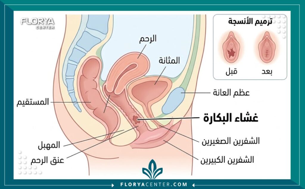 رسم توضيحي طبي يشرح تشريح منطقة الغشاء والتقنيات المستخدمة في عملية الترميم الطبي.