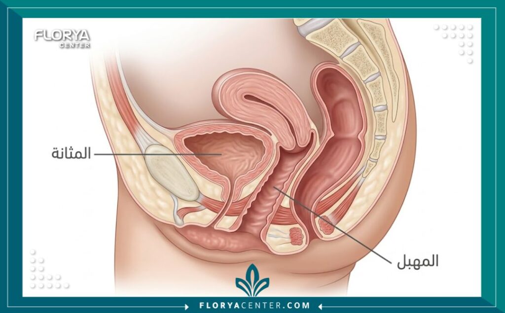 عملية رفع المثانة والمهبل 2 رسم توضيحي طبي يوضح تشريح الحوض وهبوط المثانة والمهبل قبل العملية.