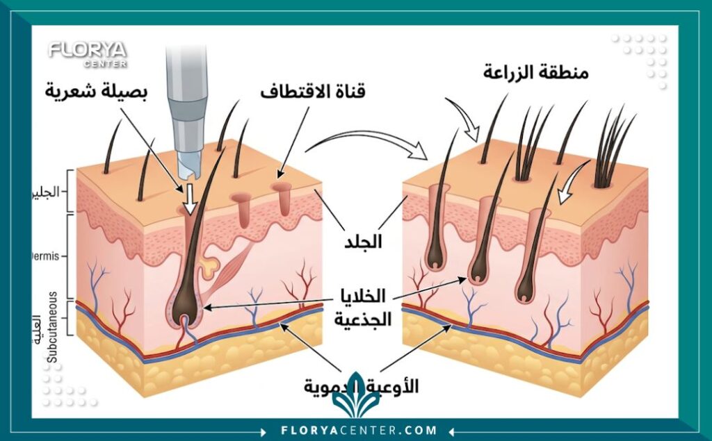 رسم توضيحي طبي لتشريح فروة الرأس يوضح عملية اقتطاف وزراعة البصيلات الشعرية (زراعة الشعر بالكامل) بالتفصيل، مع تسميات عربية.