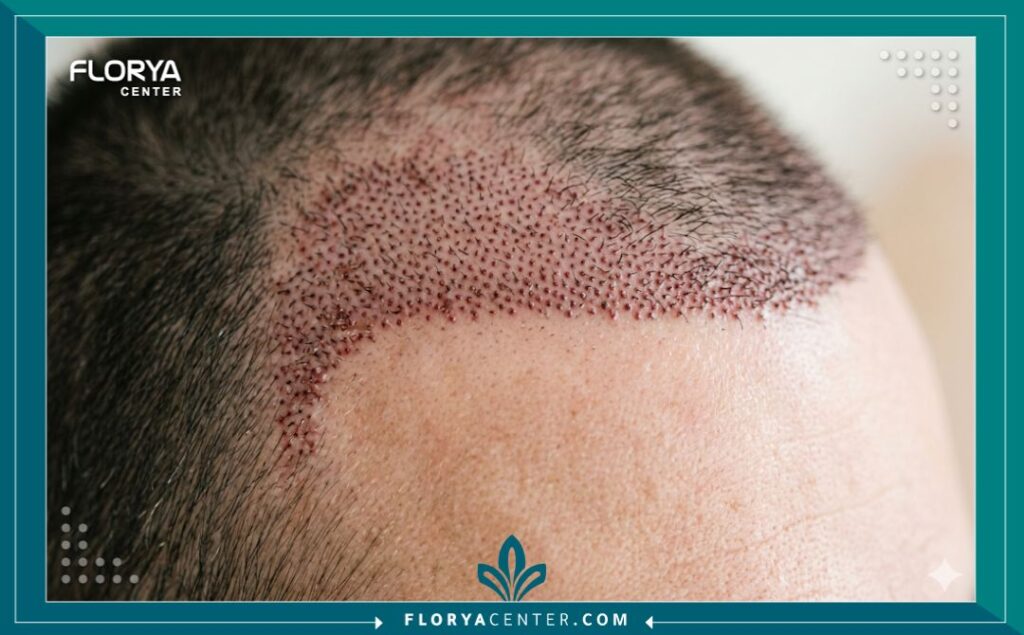 لقطة مكبرة جمالية تظهر الدقة والكثافة العالية لبصيلات الشعر المزروعة حديثاً في خط الشعر الأمامي، ضمن عملية زراعة شعر الرأس بالكامل.