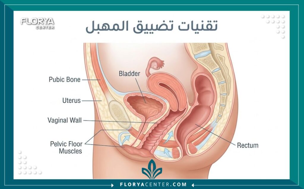 رسم توضيحي طبي يوضح عملية تضييق وجراحة المهبل في عيادات تركيا.
