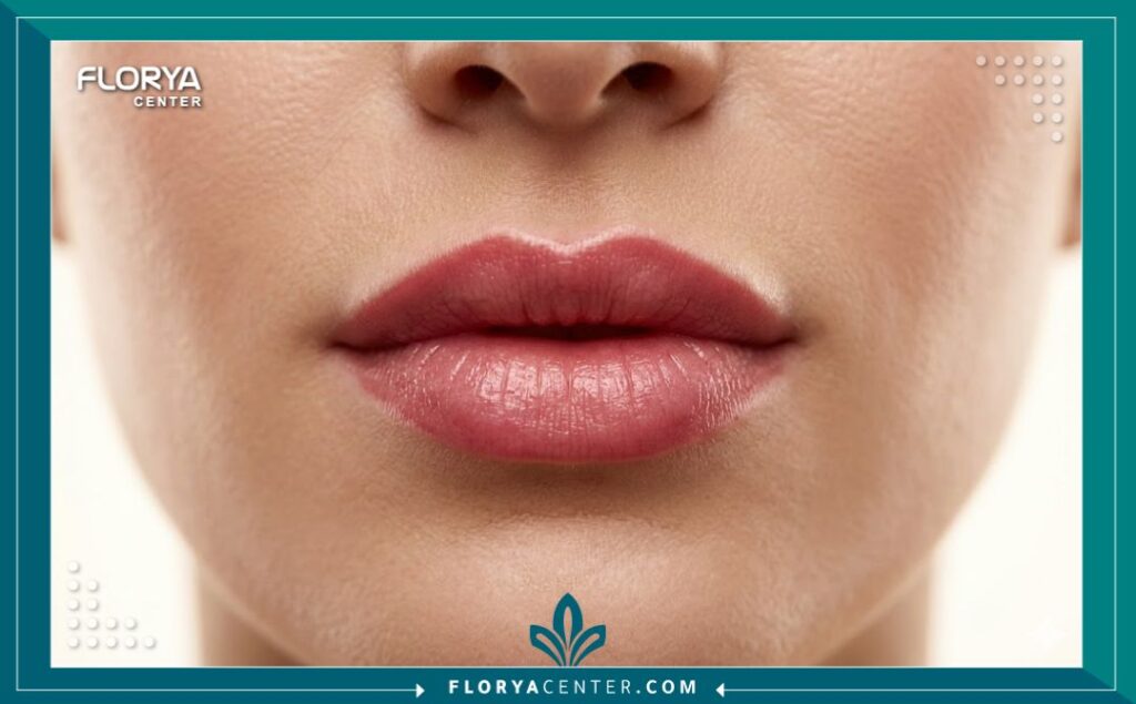 صورة مقربة جداً تبرز زمّة الشفايف وتكبير الحجم وتحديد الكونتور بشكل مثالي بعد الفيلر