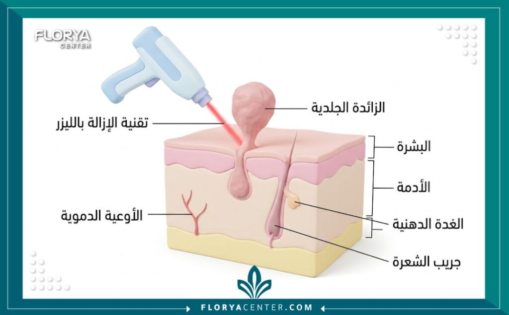 رسم توضيحي طبي يظهر الزوائد الجلدية المهبلية وطريقة التعامل الطبي معها.